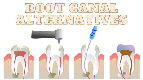 natural way to reverse a root chanel|Root Canal Alternatives: Everything You Need to Know .